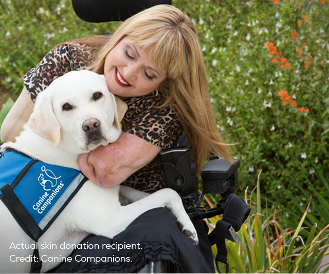 Skin donation recipient Annette Ramirez is shown here with here Canine Companion, Patch. Photograph credit: Canine Companions.